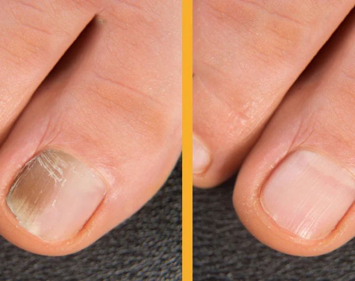 Stronger nails after using hydrolyzed marine collagen